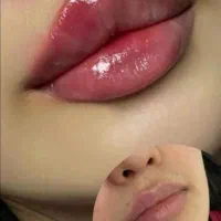 ژل فیلرلب چونه گونه اف ویژه نورامیس کاملا تخصصی|خدمات آرایشگری و زیبایی|زاهدان, |دیوار