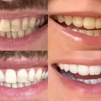 جرم‌گیری و بلیچینگ ویژه با تخفیف در غرب تهران