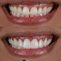 کامپوزیت/لمینیت/ایمپلنت/عصب کشی،و درمانی اقساطی|خدمات آرایشگری و زیبایی|مشهد, جنت|دیوار