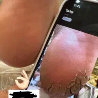 درمان خشکی و ترک کف پا درمانی با دستگاه|خدمات آرایشگری و زیبایی|تربت‌حیدریه, نواب صفوی|دیوار