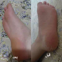 ترک پا