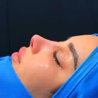 مشاوره دقیق جراحی بینی آف در بیمارستان ۴۵