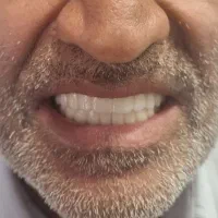 انجام کلیه خدمات دندانپزشکی و ایمپلنت اقساط ویژه