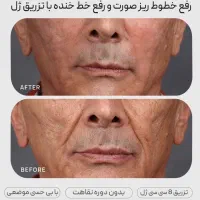 تزریق ژلوبوتاکس تخصصی در پرندبا نازلترین قیمت|خدمات آرایشگری و زیبایی|پرند, فاز ۲|دیوار