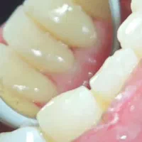 جرم گیری و بروساژ دندان