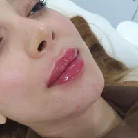 تزریق ژل و بوتاکس و هایفوتراپی پروفایلو فیلر بادی|خدمات آرایشگری و زیبایی|شیراز, فرهنگ شهر|دیوار