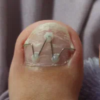 .پدولوژی ودرمان تخصصی عارضه های ناخن وپوست پا