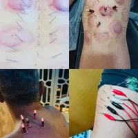 دیسک سیاتیک فیزیوتراپی کاردرمانی زالو درمانی حجامت|خدمات آرایشگری و زیبایی|تهران, ارامنه|دیوار