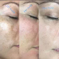 خدمات حجامت بادکش زالودرمانی فصد خون