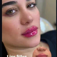 تخفیف تزریق ژل وبوتاکس|خدمات آرایشگری و زیبایی|آمل, |دیوار