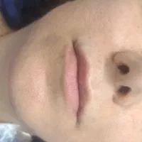 بوتاکس فقط ۸۰۰ ژل هر سی سی ۹۰۰رفع خط غم و لبخند|خدمات زیبایی و سلامت|تهران, دستغیب|دیوار