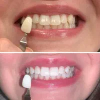 سفیدکردن دندان. بیلیچینگ|خدمات آرایشگری و زیبایی|مشهد, هفت تیر (نه دره)|دیوار