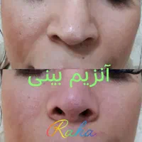 ژل/بوتاکس/آنزیم/مزو فقط ۳۰۰|خدمات آرایشگری و زیبایی|کرج, گوهردشت|دیوار