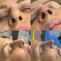 عمل زیبایی بینی با بهترین متد|خدمات آرایشگری و زیبایی|کرج, اتحاد|دیوار