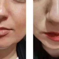 کوچیک کننده دماغ