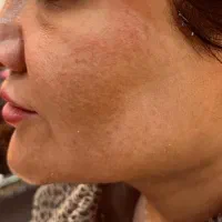 درمان افتادگی غبغب بازو وشکم وصورت|خدمات آرایشگری و زیبایی|قم, سالاریه|دیوار