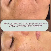 فیشال و پاکسازی پوست|خدمات آرایشگری و زیبایی|اصفهان, فجر|دیوار