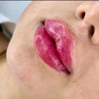 تزریق ژل‌فیلر،لب،گونه‌(جشنواره یلدا)درمطب فقط499ت