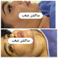 ساکشن غبغب تزریق چربی ۲م فقط