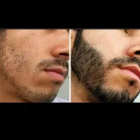 رویش انفجاری و قطع ریزش