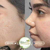 پی آر پی، جوانسازی درمان جوش جای جوش و اسکار پوست