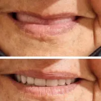 دندانسازی(دندان مصنوعی)|خدمات آرایشگری و زیبایی|اصفهان, وحید|دیوار