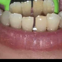 تخفیف ویژه جرمگیری تا ۱۵ آذر فقط ۱۸۰۰|خدمات آرایشگری و زیبایی|رشت, گلسار|دیوار