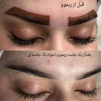خدمات پاک کردن تتو در یک جلسه