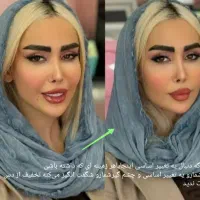 برداشتن خال،ژل،بوتاکس،انزیم،مزوکلنیک ایرانیان|خدمات آرایشگری و زیبایی|کرمانشاه, |دیوار