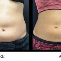 خدمات لاغری بدون جراحی و سلامت پوست