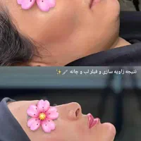 تخفیف ویژه ژل لب فقط۸۵۰