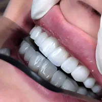کامپوزیت/لمینیت/ایمپلنت بااقساط ویژه