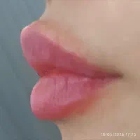 ژل و بوتاکس کل صورت و خدمات پرسینگ. میکروبلدینگ