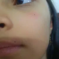 حذف خال ،زگیل فقط با قطره|خدمات آرایشگری و زیبایی|سبزوار, غرب نیروگاه|دیوار