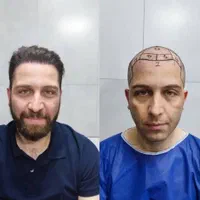 کاشت مو در یکروز|خدمات آرایشگری و زیبایی|تهران, گاندی|دیوار
