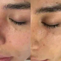 آموزش فشیال و درمان پوست (تخصصی پزشکی)