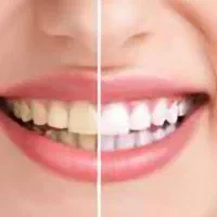 ویدلمینت ASL