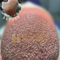 خدمات زیبایی کاشت مو و ابرو