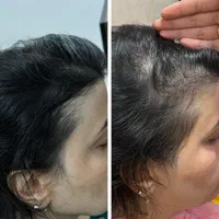 پاکسازی سر،موخوره گیری،اسکالپ،درمان ریزش،رویش مجدد|خدمات آرایشگری و زیبایی|قم, هفت تیر|دیوار