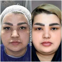 ساکشن شکم ترنسفر تزریق بلفارو اپیکانتوپلاستی|خدمات آرایشگری و زیبایی|مشهد, هفت تیر (حافظ)|دیوار
