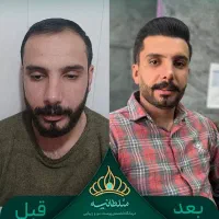 کاشت مو زیر نظر معجزه‌گر کاشت مو ایران