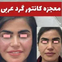 ژل و بوتاکس|خدمات آرایشگری و زیبایی|جیرفت, |دیوار