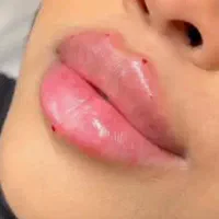 تخفیف بوتاکس و فیلر صورت و بادی و فیلر لب