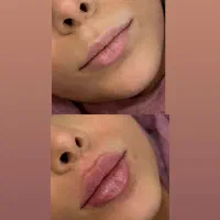 جشنواره عیدانه ژل لب بوتاکس گرگان