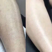 لیزربدن فول بادی تضمینی(۵۵۰تومن)جلسه آخربدون هزینه