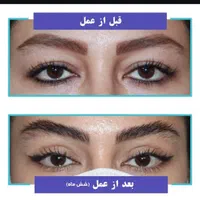 بلفارو پلاستی توسط پزشک 7900 ژل بوتاکس مادلینگ