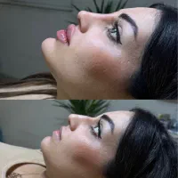 اصلاح تخصصی فرم بینی بدون عمل(دکتر زرین) فیلرنخ ژل|خدمات زیبایی و سلامت|تهران, الهیه|دیوار