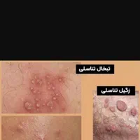 زگیل تناسلی|خدمات آرایشگری و زیبایی|تبریز, |دیوار