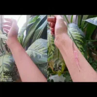 ترمیم زخم سوختگی