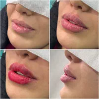 تزریق ژل بوتاکس مادلینگ و ساکشن غبغب|خدمات آرایشگری و زیبایی|تهران, آسمان|دیوار